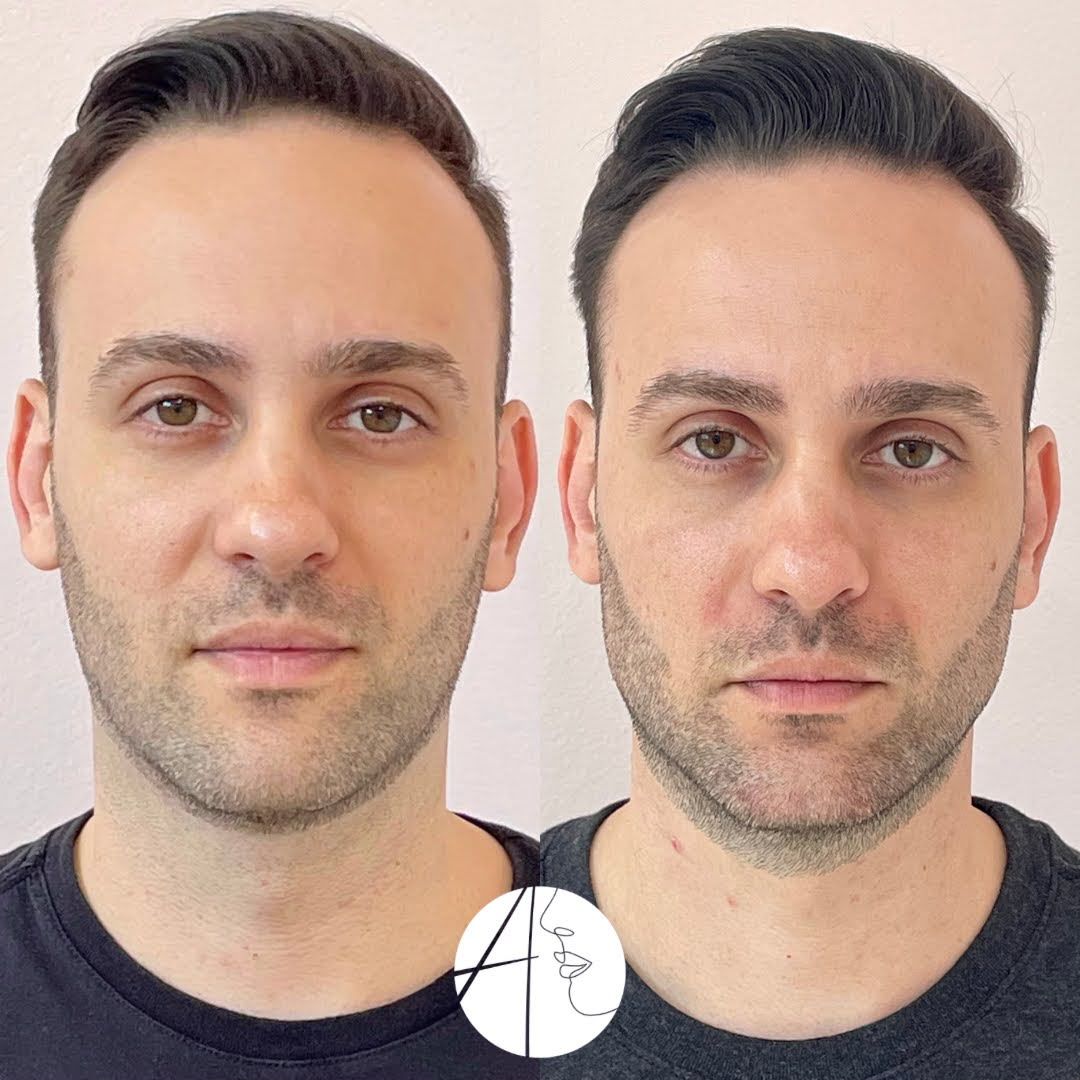 Antes e depois: rosto, vista frontal, caso clínico da Dra. Andressa Thomazzoni