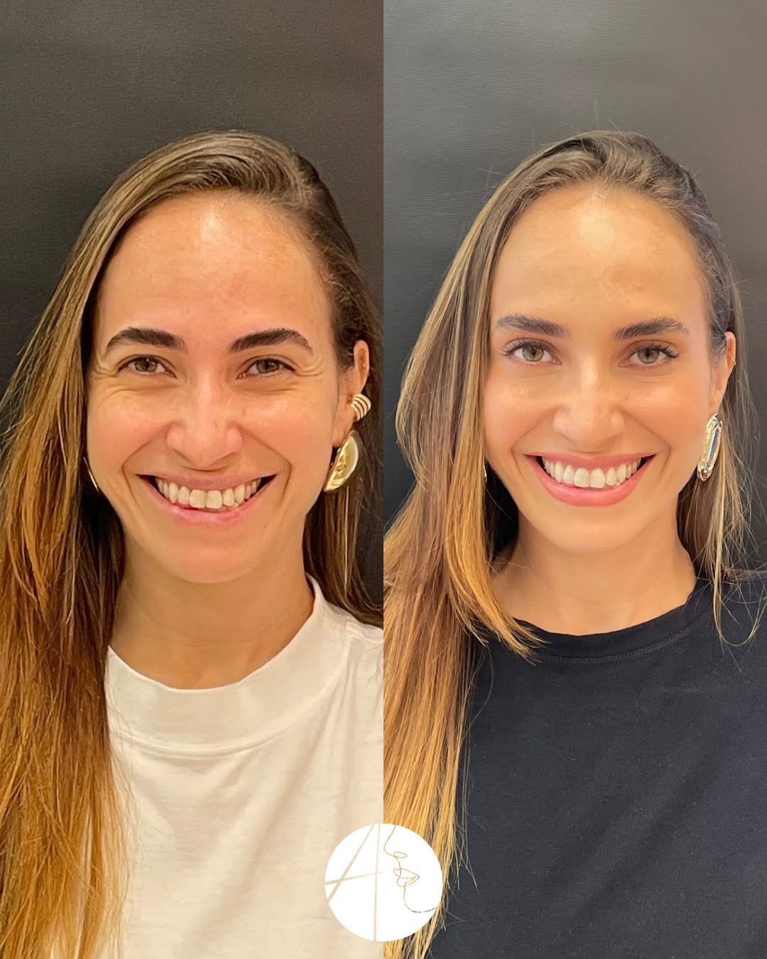 Antes e depois: rosto, vista frontal, caso clínico da Dra. Andressa Thomazzoni