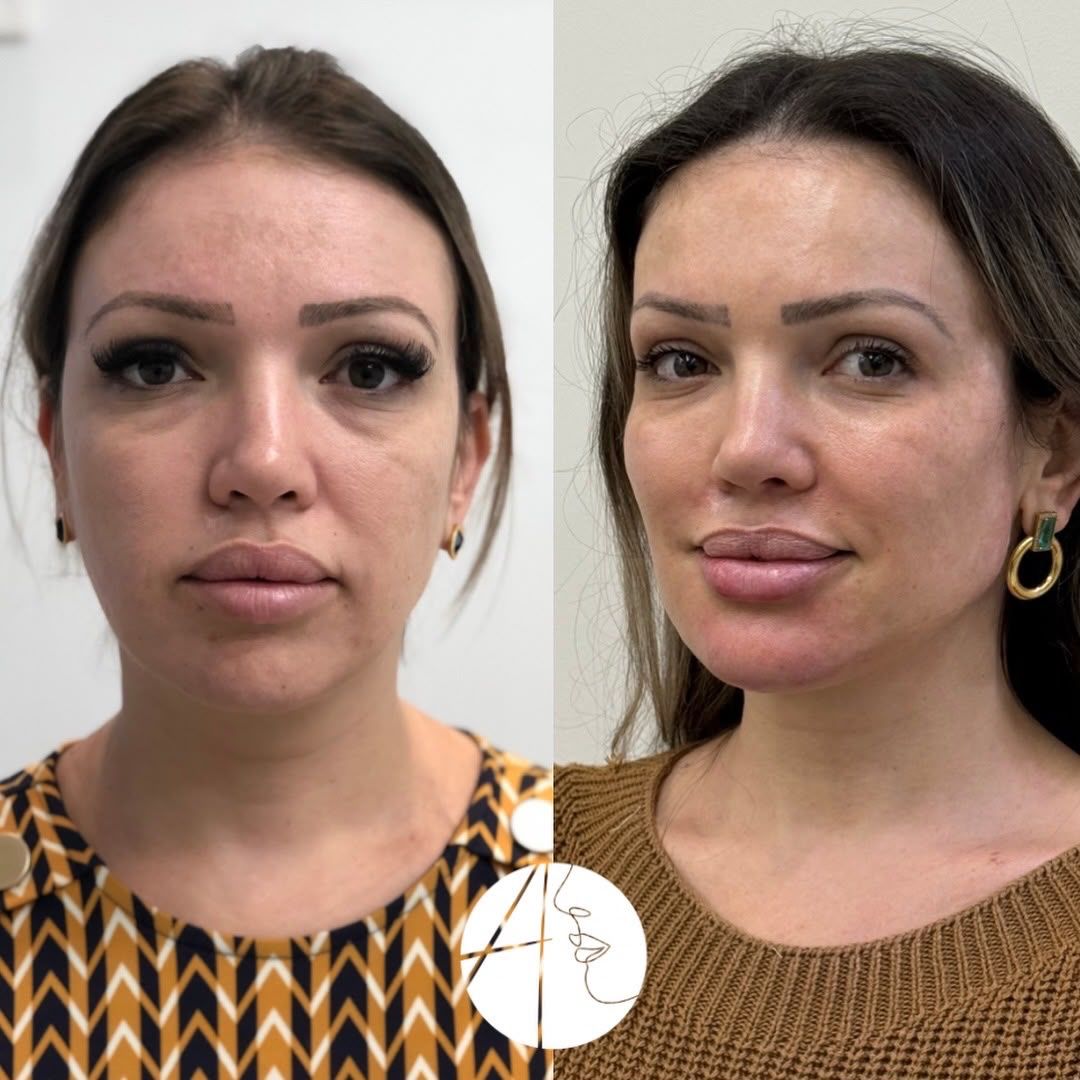 Antes e depois: rosto, vista frontal, caso clínico da Dra. Andressa Thomazzoni
