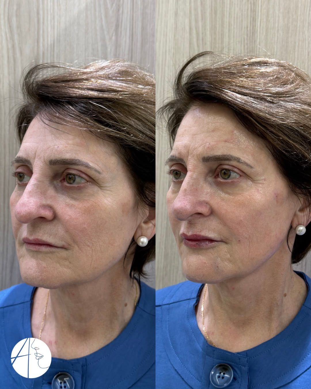 Antes e depois: rosto, vista oblíqua, caso clínico da Dra. Andressa Thomazzoni